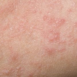 Noreva_Peau_Eczeane-peau rouge qui gratte_Signe3_540x540