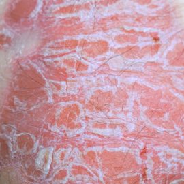 Noreva_Peau_Psoriasis_PlaquesRouges_540x540
