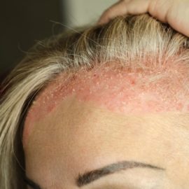 Noreva_Peau_Psoriasis_SquamesCheveux_540x540