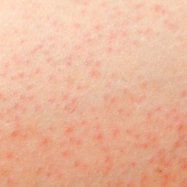 Noreva_Peau_RecheRugueuse_BoutonsPoilsincarnes_540x540