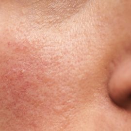 Noreva_Peau_Sensible_Couperose_540x540