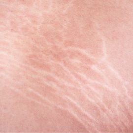 Noreva_Peau_Vergetures_Vergetures_540x540